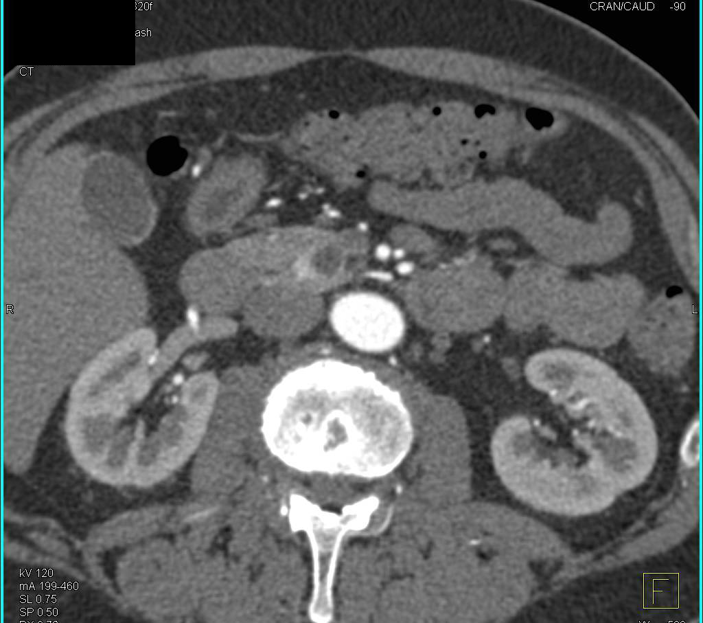 Cystic Neuroendocrine Tumor of the Pancreatic Head with Enhancement on Arterial Phase - CTisus CT Scan