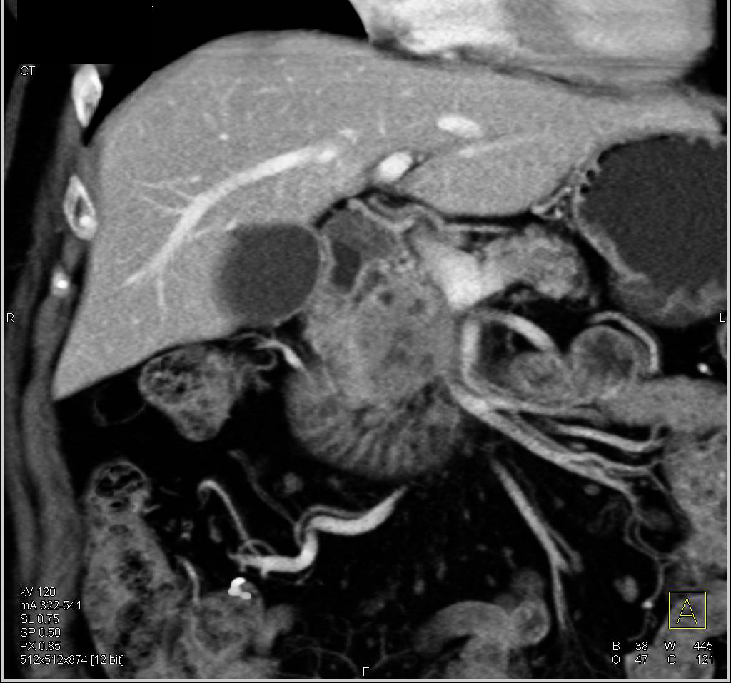 Adenocarcinoma of the Head of the Pancreas - CTisus CT Scan