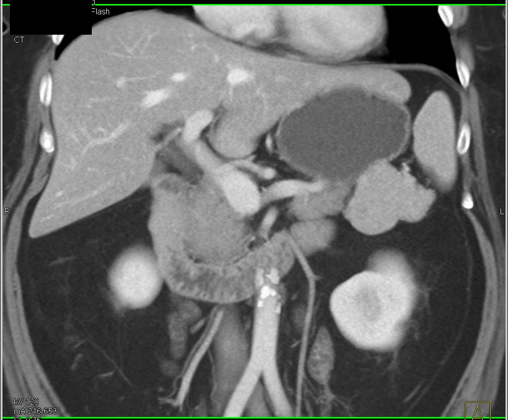 Neuroendocrine Tumor of the Pancreatic Tail Looks Like an Accessory Spleen - CTisus CT Scan