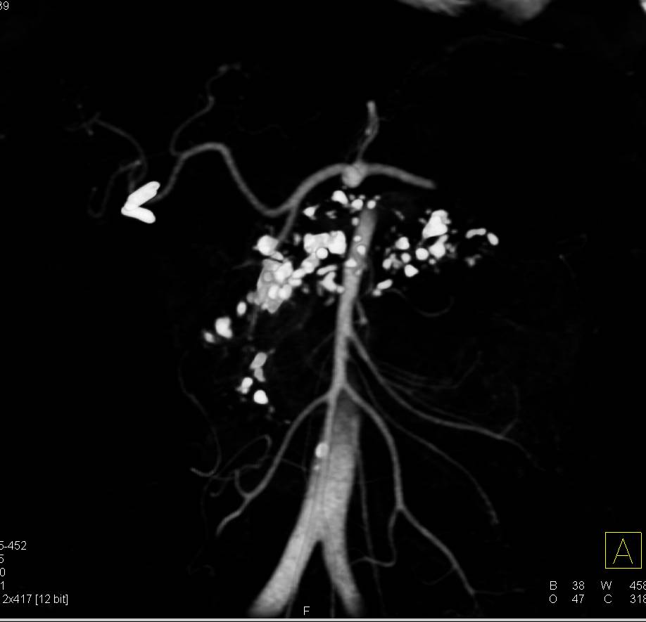 Chronic Pancreatitis - CTisus CT Scan