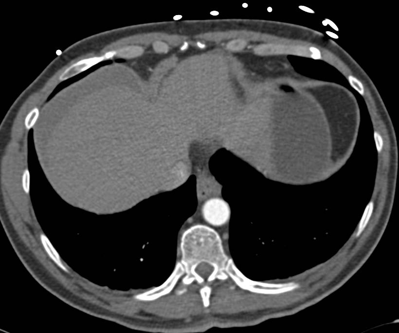 Acute Pancreatitis Following an Endoscopic Retrograde Cholangiopancreatography (ERCP) with Peripancreatic Inflammation - CTisus CT Scan