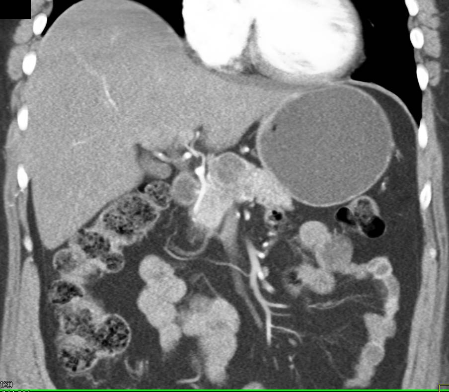 Pancreatic Adenocarcinoma - CTisus CT Scan