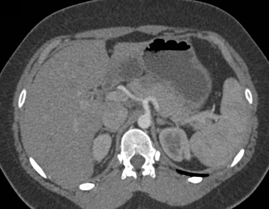 Subtle Carcinoma of the Body of the Pancreas - CTisus CT Scan