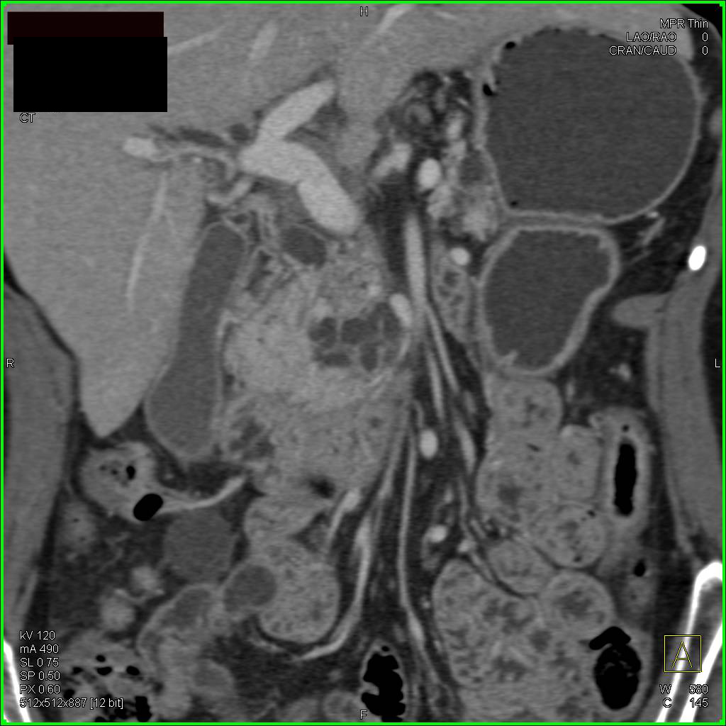 Intraductal Papillary Mucinous Neoplasm (IPMN) looks like a Cystic Pancreas Mass like Serous Cystadenoma - CTisus CT Scan