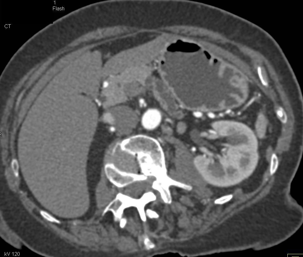 Subtle Pancreatic Cancer Obstructs the Pancreatic Duct - CTisus CT Scan