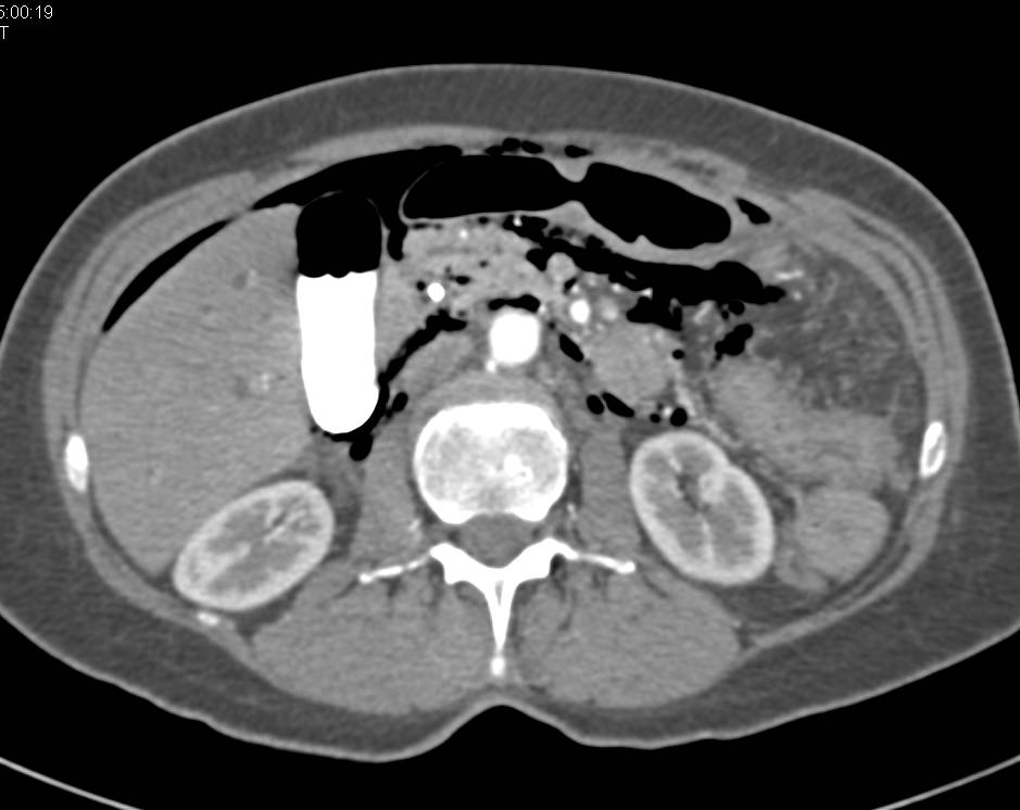 Pneumoperitoneum as a Complication of Endoscopic Retrograde Cholangiopancreatography (ERCP) with Perforation - CTisus CT Scan