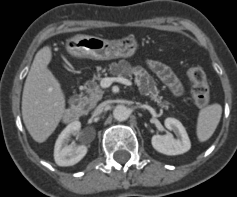 Multiple Intraductal Papillary Mucinous Neoplasms (IPMNs) Throughout the Pancreas with Early Dysplasia - CTisus CT Scan