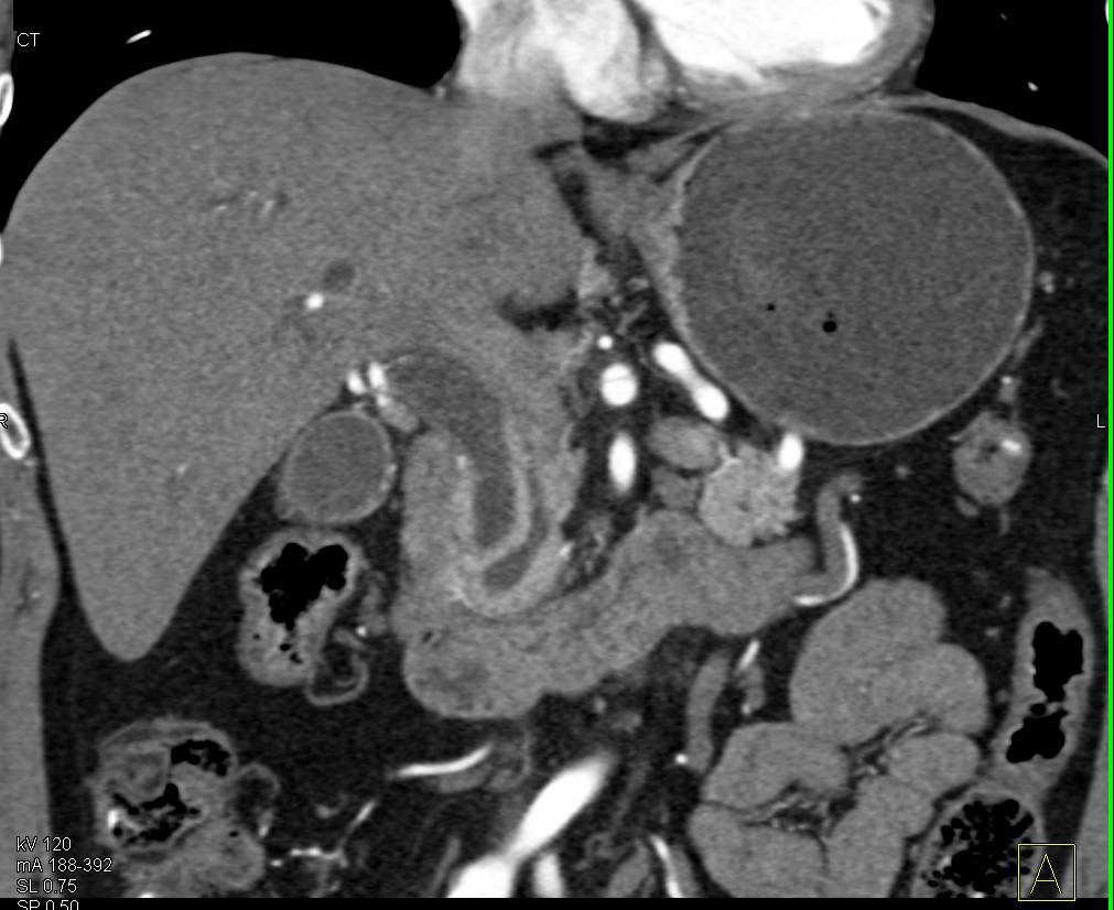 Ampullary Carcinoma with Double Duct Sign - CTisus CT Scan