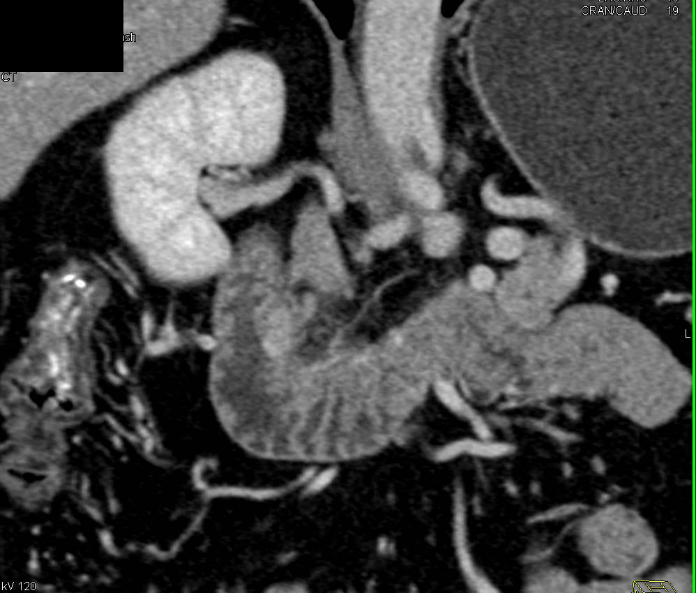 Subtle Ampullary Carcinoma - CTisus CT Scan