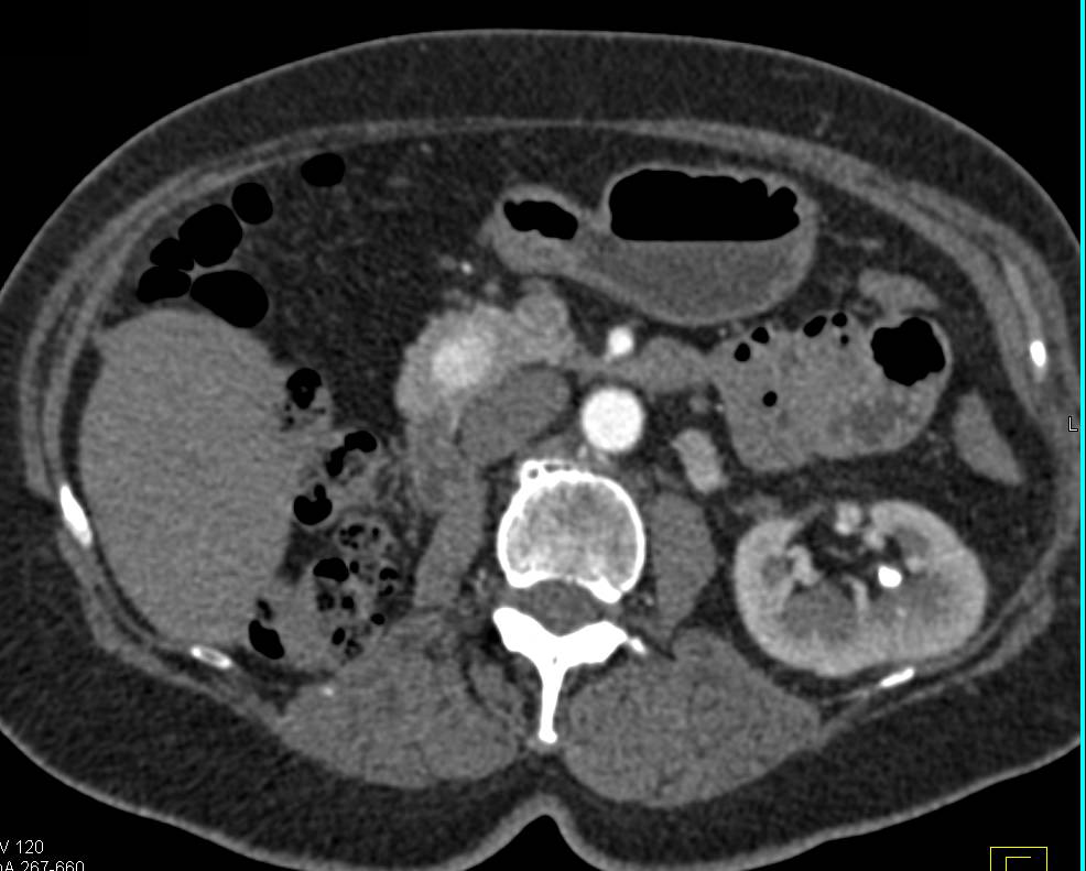 Metastatic Renal Cell carcinoma to the Head of the Pancreas with a Vascular Metastases - CTisus CT Scan