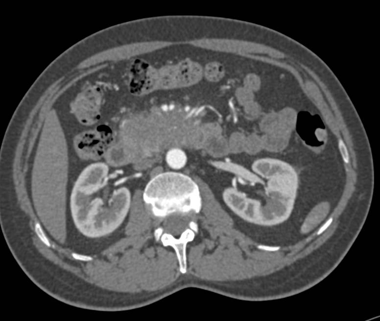 Adenocarcinoma of the Head of the Pancreas with Arterial and Venous Infiltration - CTisus CT Scan