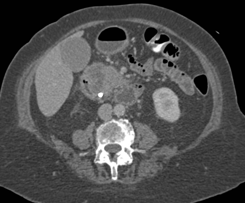 Adenocarcinoma of the Head of the Pancreas - CTisus CT Scan