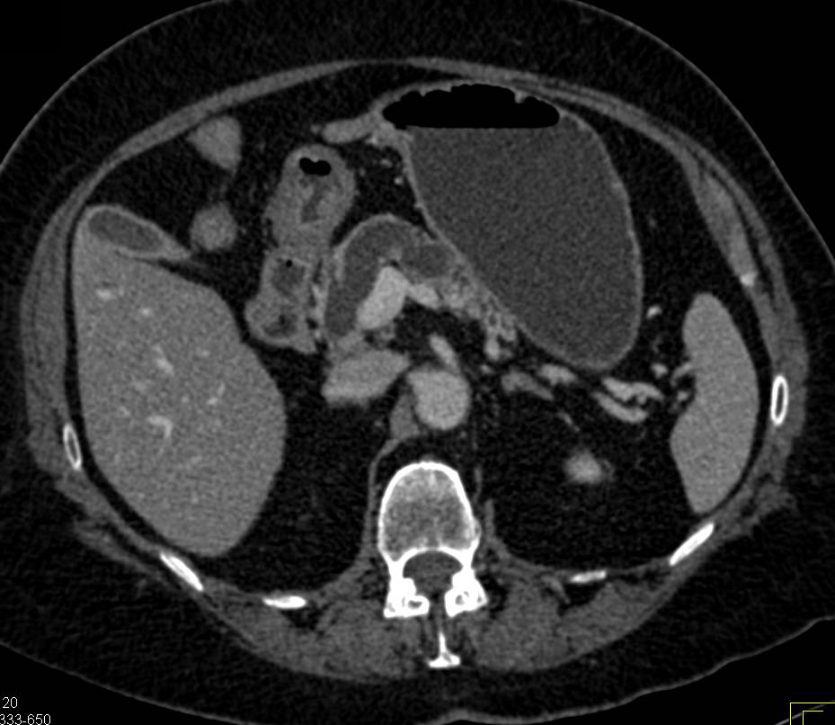 Ampullary Cancer with a Double Duct Sign and Impressive Pancreatic Duct Dilatation - CTisus CT Scan