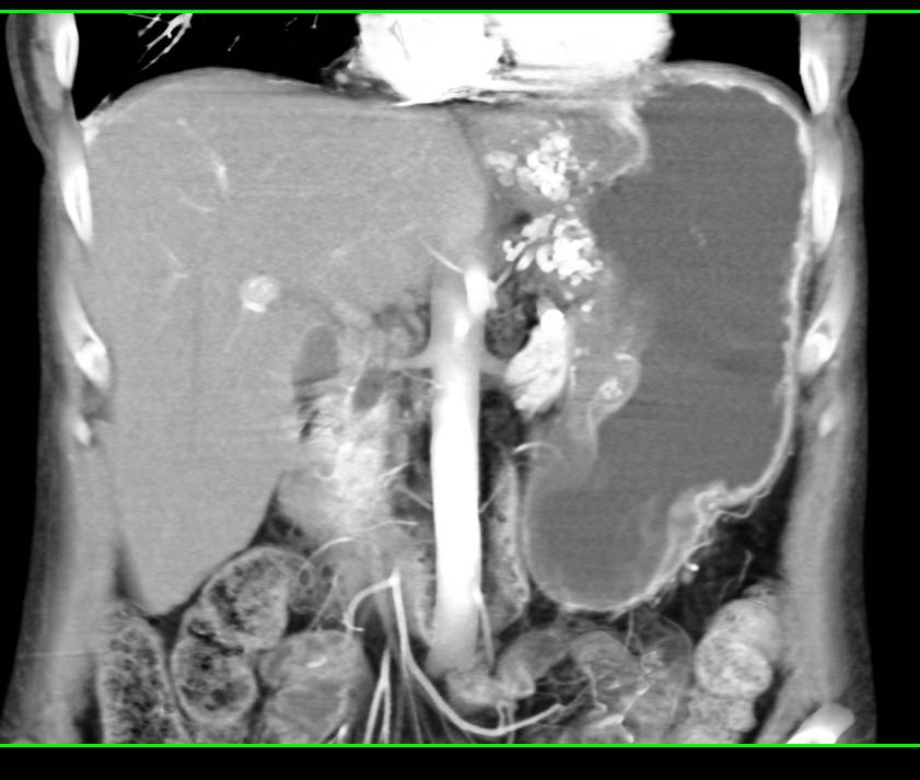 Intraductal Papillary Mucinous Neoplasm (IPMN) - CTisus CT Scan