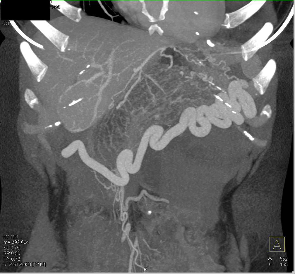 MCN or Mucinous Cystic Neoplasm of the Pancreas - CTisus CT Scan