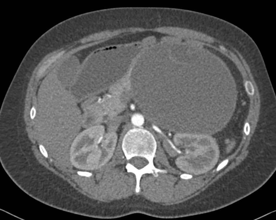 Pancreatic Pseudocyst with Compressed Vessels - CTisus CT Scan