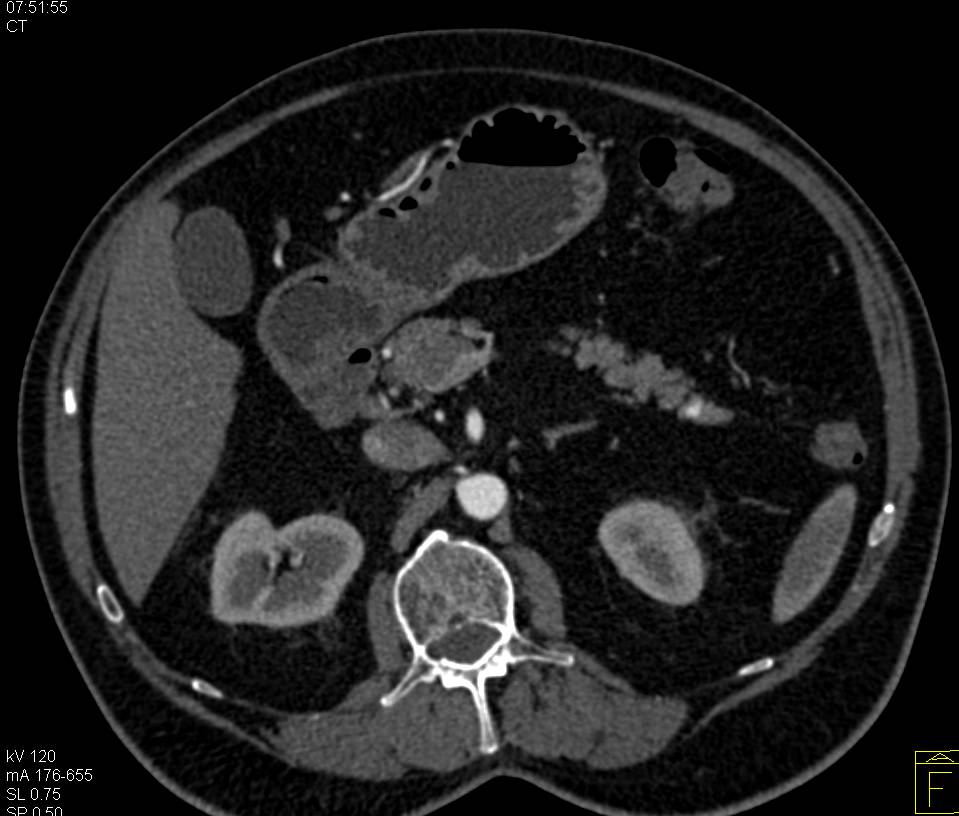 5 mm Neuroendocrine Tumor in Tail of Pancreas Can Be Confused with Splenic Artery - CTisus CT Scan