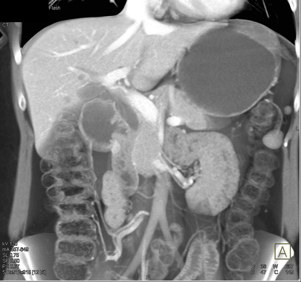 Ampullary Carcinoma with Dilated Common Bile Duct (CBD) - CTisus CT Scan