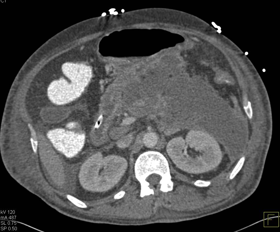 Acute Pancreatitis with Pancreatic Necrosis Involves the Left Anterior Pararenal Space - CTisus CT Scan