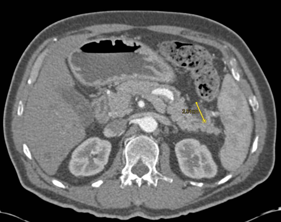 Intraductal Papillary Mucinous Neoplasm (IPMN) - CTisus CT Scan