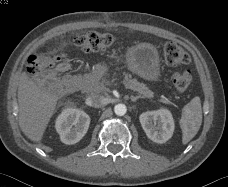 Recurrent Pancreatic Cancer s/p Whipple Procedure - CTisus CT Scan