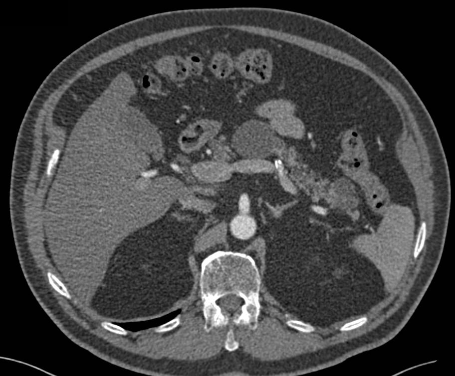 Multiple Intraductal Papillary Mucinous Neoplasms (IPMNs) in the Pancreas - CTisus CT Scan