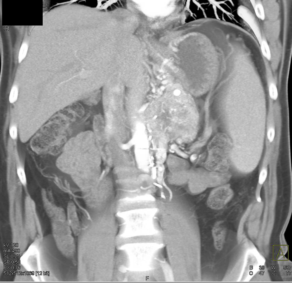 Neuroendocrine Tumor in the Left Para-Aortic Zone Invades into the Portal Vein - CTisus CT Scan