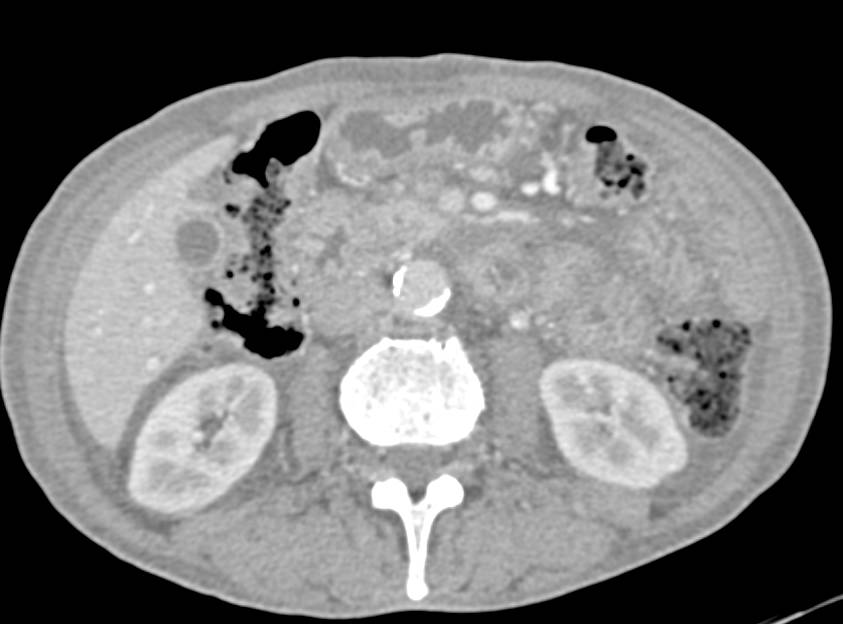 Pancreatic Mass Occludes Portal Vein-Superior Mesenteric Vein (SMV) Junction - CTisus CT Scan