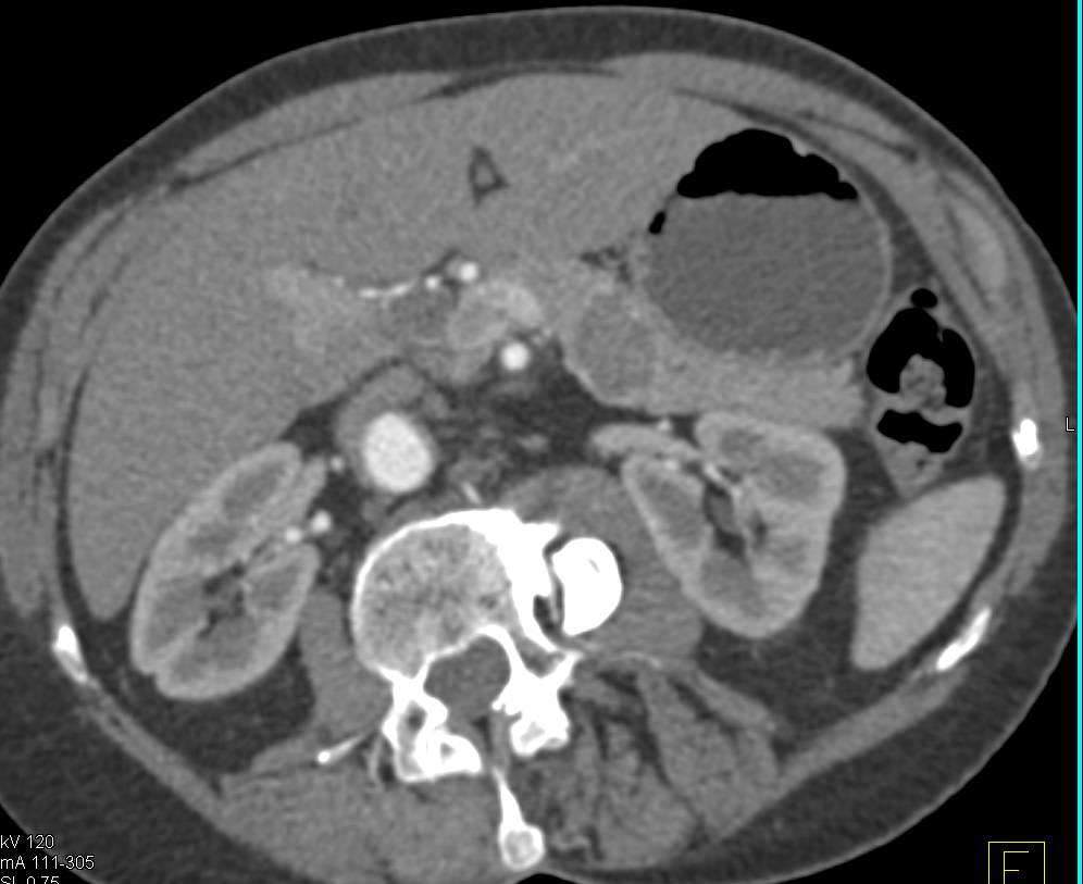 Serous Cystadenoma of the Body of the Pancreas - CTisus CT Scan