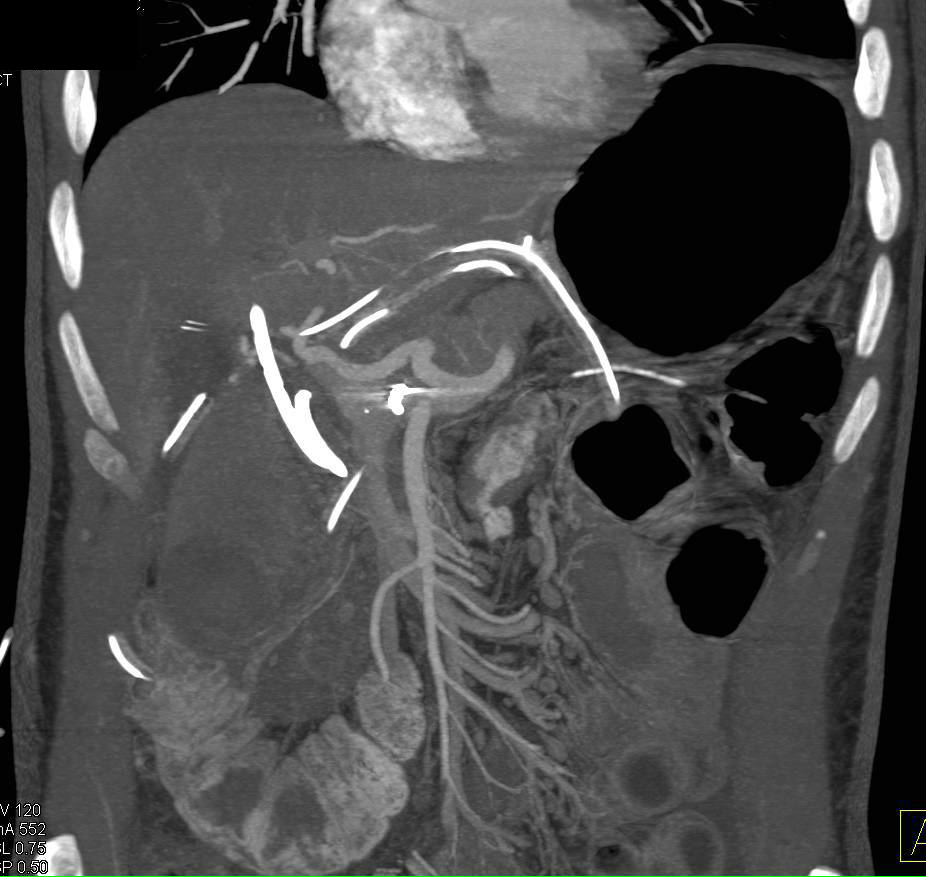 Active Bleed into Collection s/p Whipple Procedure - CTisus CT Scan