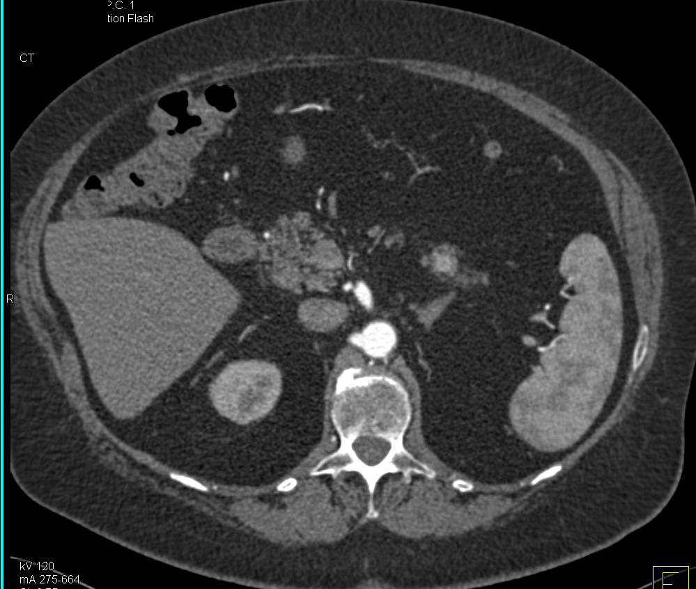 Incidental 1cm Neuroendocrine Tumor in the Tail of the Pancreas - CTisus CT Scan