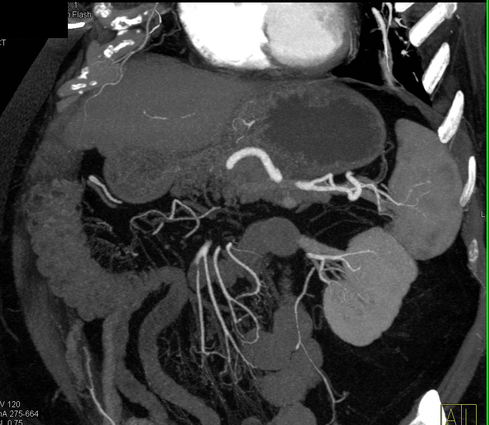 1cm Neuroendocrine Tumor Tail of Pancreas Best Seen in 3D - CTisus CT Scan