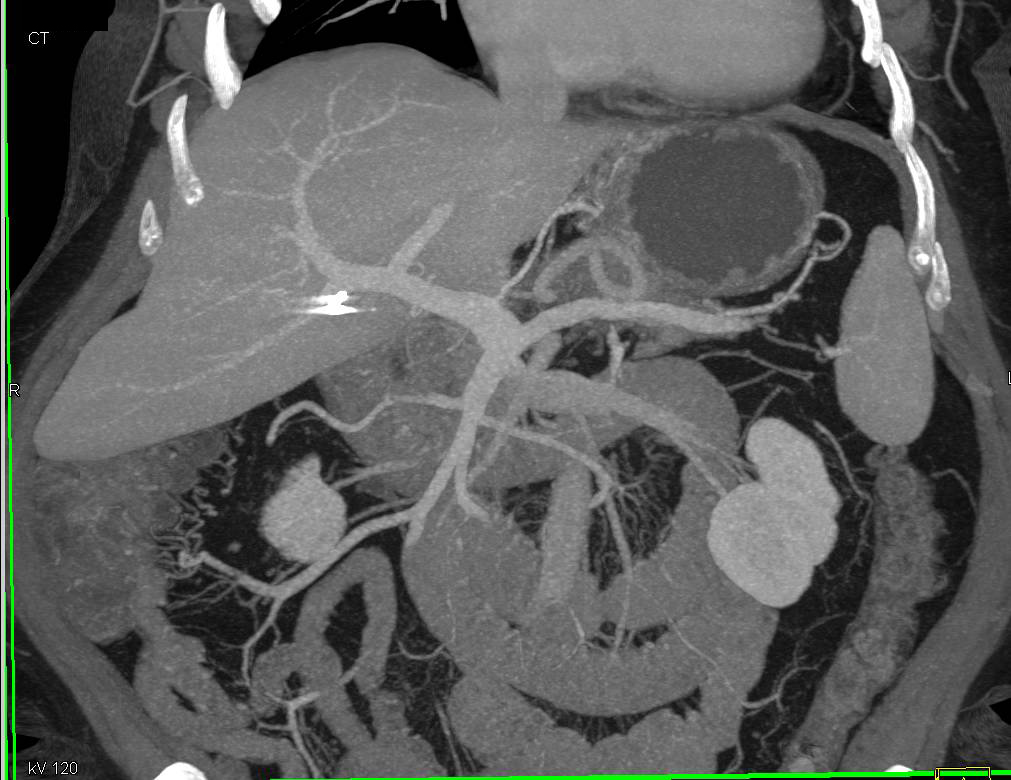 Incidental 1cm Neuroendocrine Tumor in the Tail of the Pancreas - CTisus CT Scan