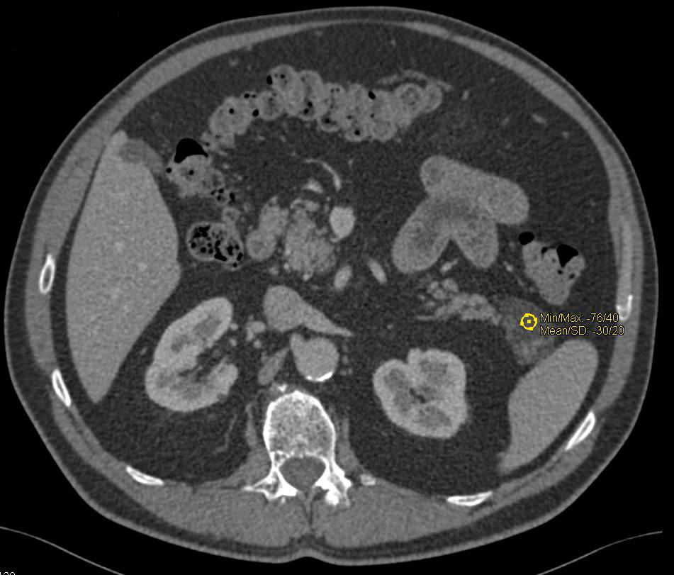 Lymphoepithelial Cyst Near Tail of the Pancreas - CTisus CT Scan