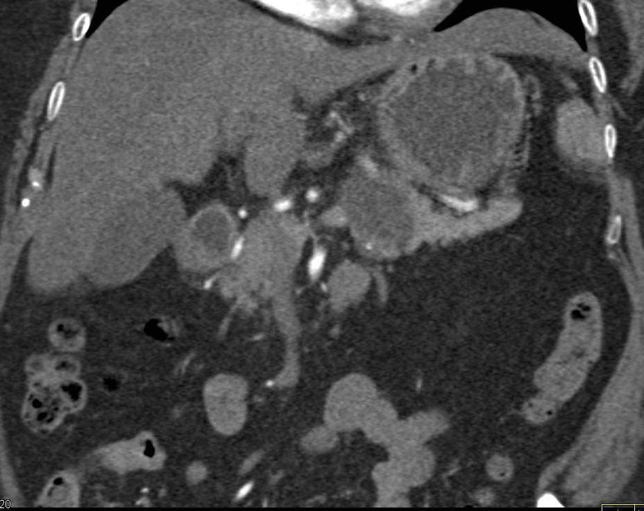 Mucinous Cystic Neoplasm of the Pancreas - CTisus CT Scan