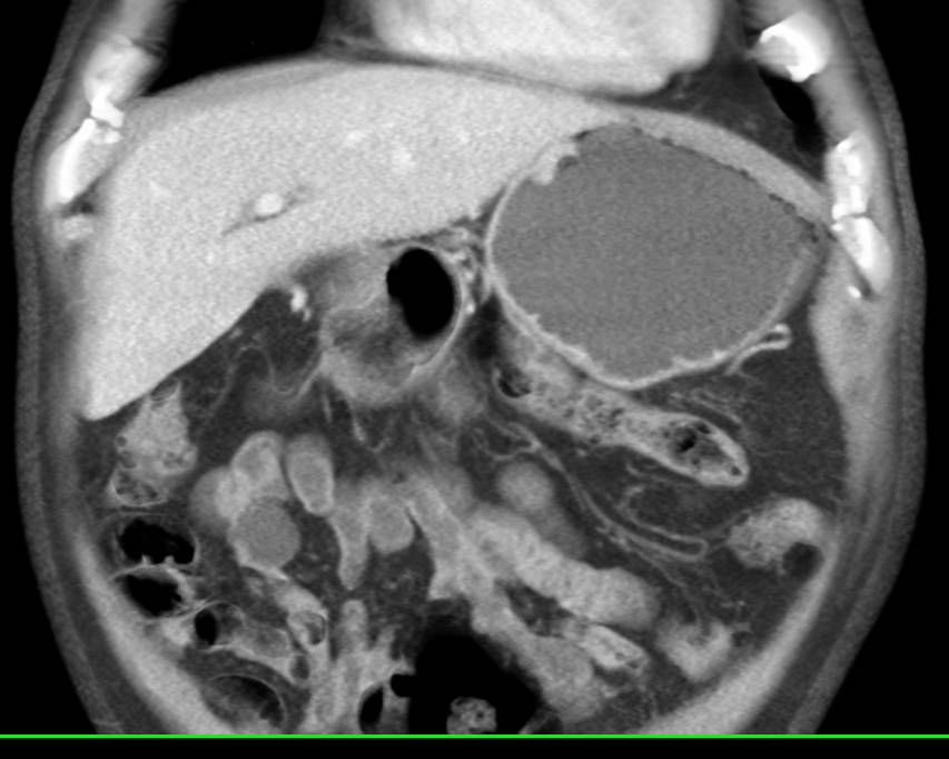 Neuroendocrine Tumor Near the Pancreas - CTisus CT Scan