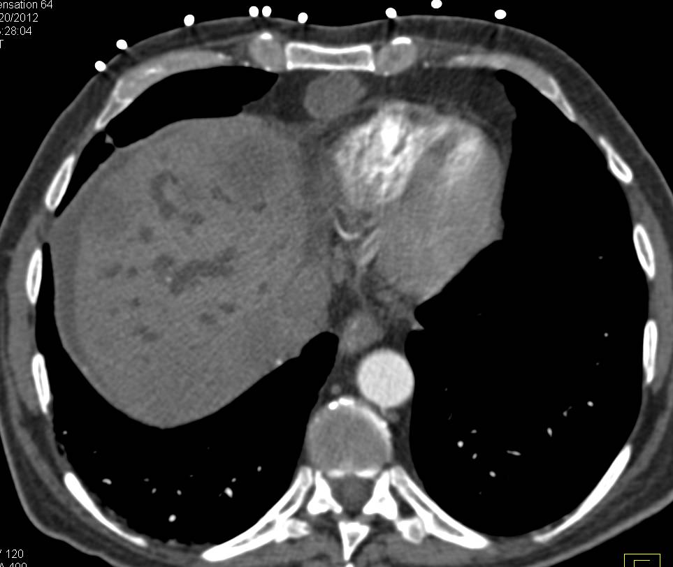 Pancreatic Adenocarcinoma with Liver Metastases and Adenopathy - CTisus CT Scan