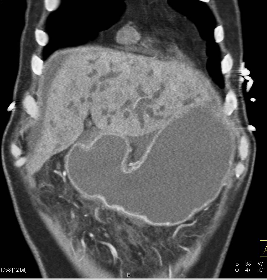 Pancreatic Cancer With Liver Metastases and Carcinomatosis - CTisus CT Scan