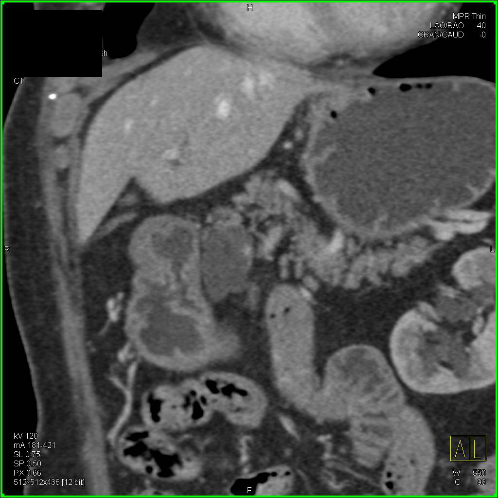 Multiple Intraductal Papillary Mucinous Neoplasms (IPMNs) in the Pancreas - CTisus CT Scan