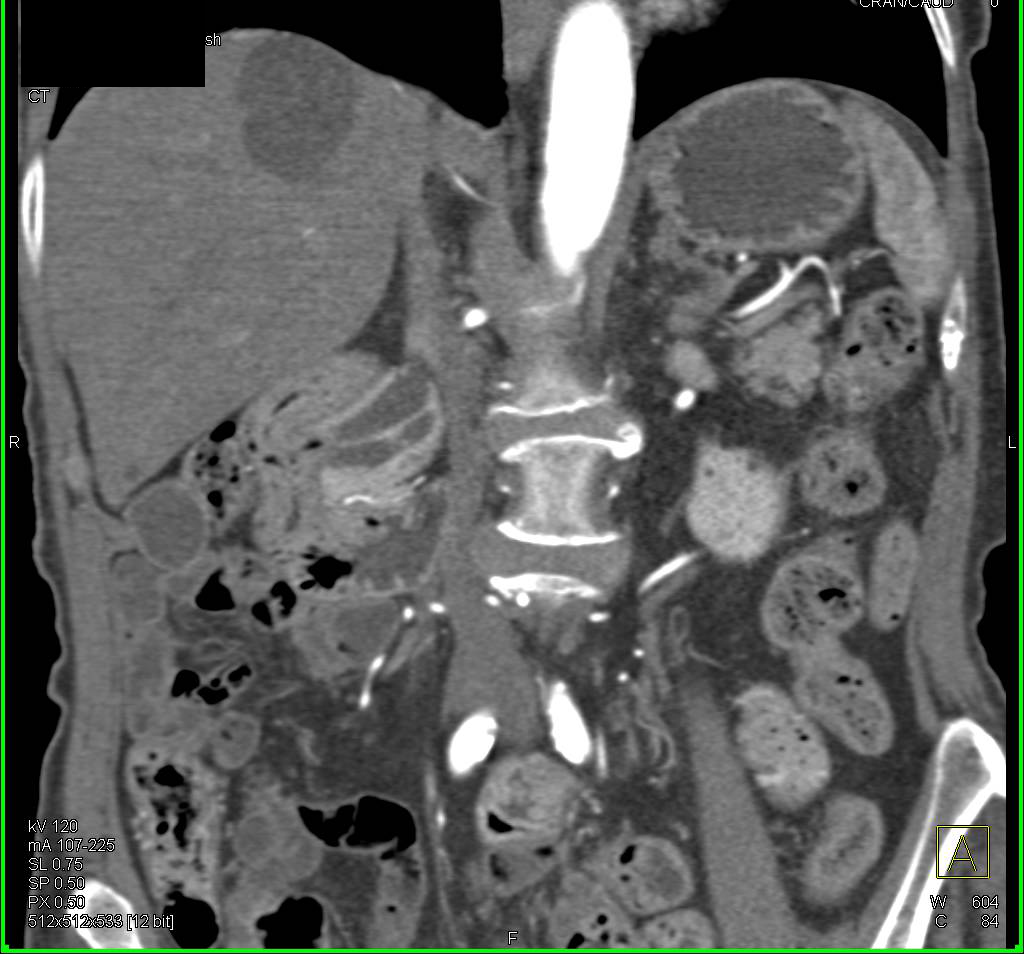 Double Duct Sign with Small Ampullary Mass - CTisus CT Scan