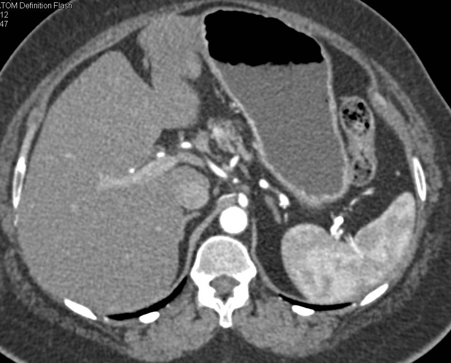 Incidental Neuroendocrine Tumor in the Body of the Pancreas - CTisus CT Scan