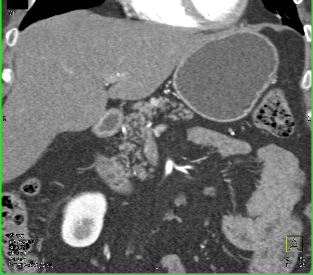 Pancreatic Neuroendocrine Tumor (PNET) - CTisus CT Scan