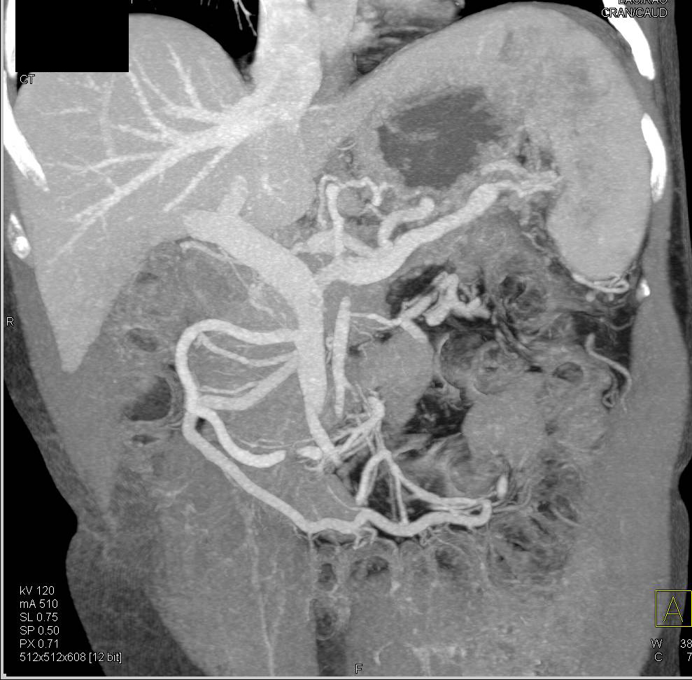 Pancreatic Adenocarcinoma Involves the Spleen - CTisus CT Scan