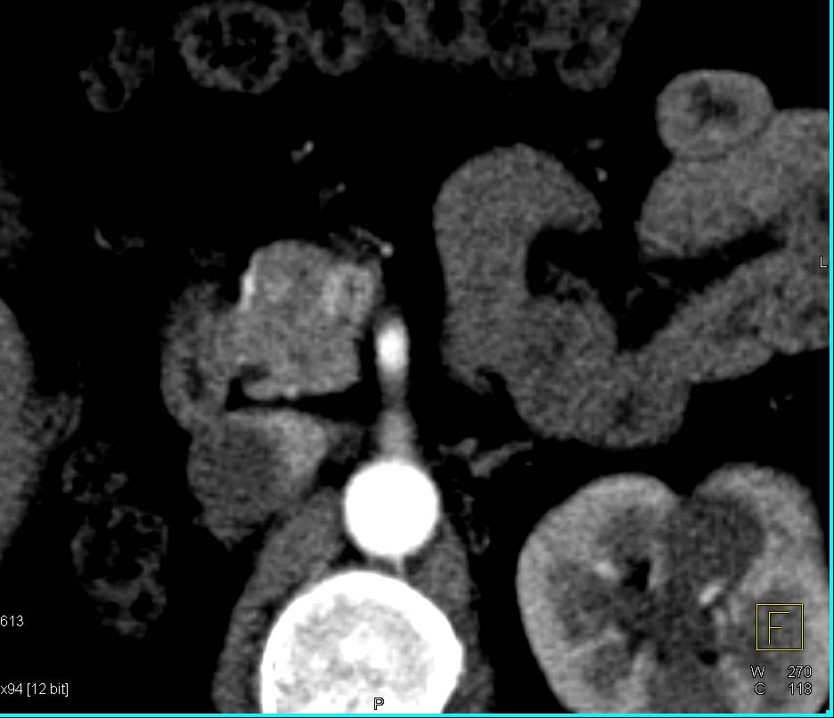 Subtle Incidental Neuroendocrine Tumor in the Head of the Pancreas - CTisus CT Scan