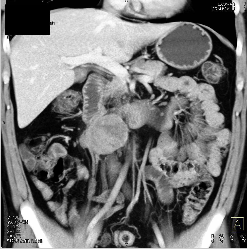 Neuroendocrine Tumor Near the Head of the Pancreas - CTisus CT Scan