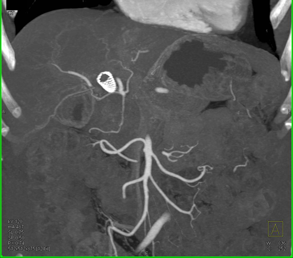 Pancreatic Cancer with Stent In the Common Bile Duct (CBD) - CTisus CT Scan