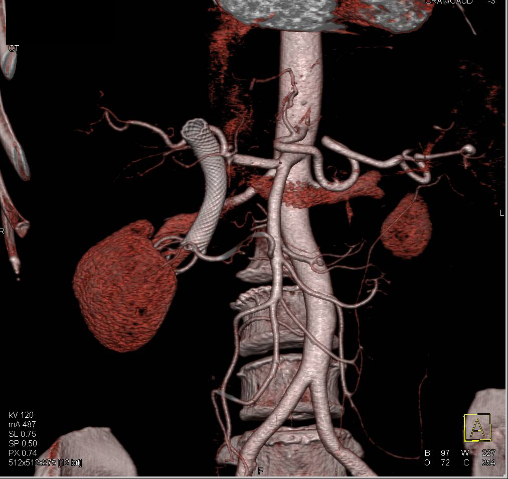 Common Duct Wall Stent and Common Hepatic off the SMA - CTisus CT Scan