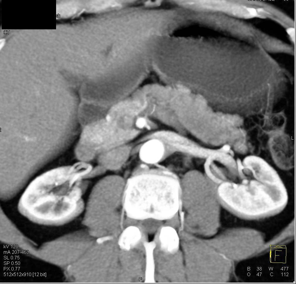 Neuroendocrine Tumor of the Pancreas - CTisus CT Scan