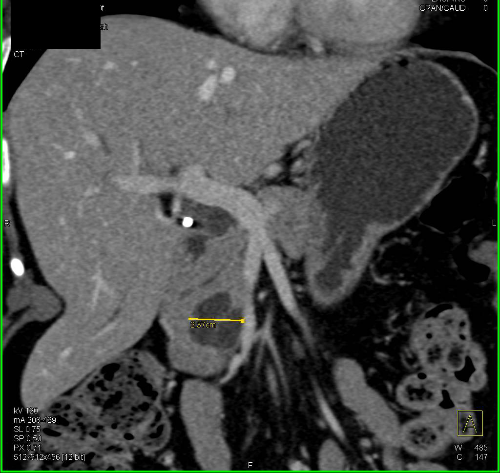 Intraductal Papillary Mucinous Neoplasm (IPMN) with Septations - CTisus CT Scan