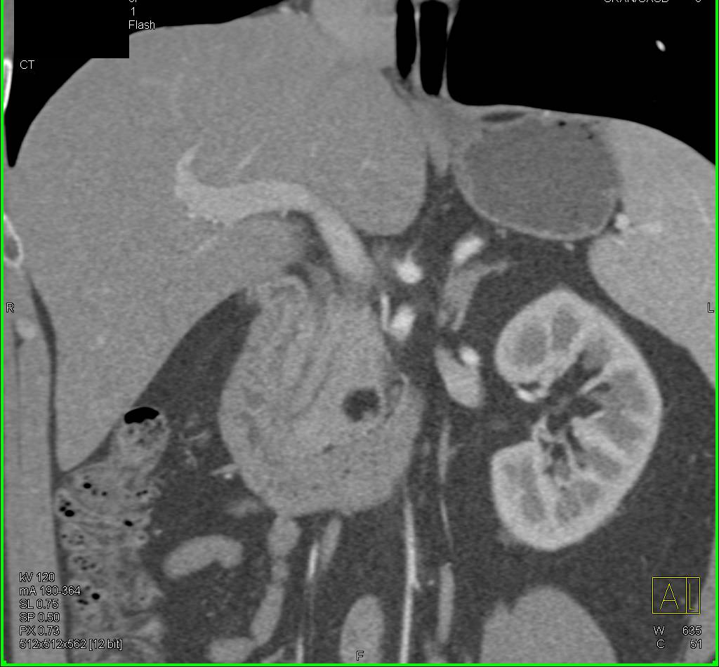 Pancreatic Lipoma - CTisus CT Scan